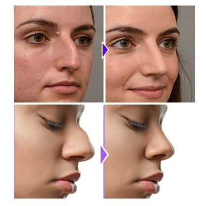 Nose Sculpting Device